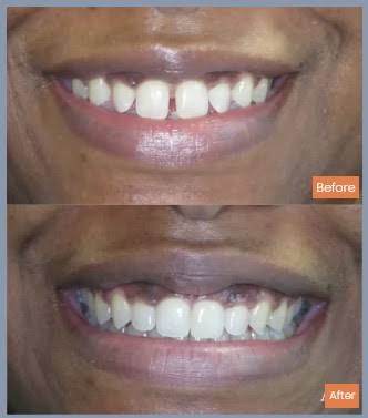 Aesthetic restoration and whitening before and after result